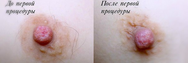 растут волосы вокруг сосков - ответа на форуме gkhyarovoe.ru ()